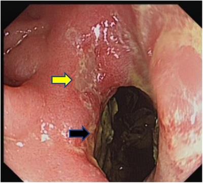 Benign duodenocolic fistula: A case report and review of the literature